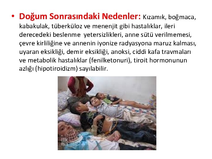  • Doğum Sonrasındaki Nedenler: Kızamık, boğmaca, kabakulak, tüberküloz ve menenjit gibi hastalıklar, ileri