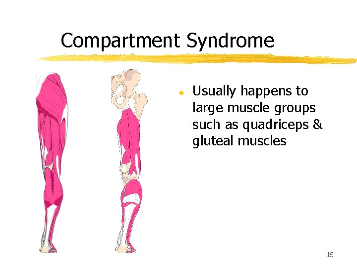 Compartment Syndrome l Usually happens to large muscle groups such as quadriceps & gluteal