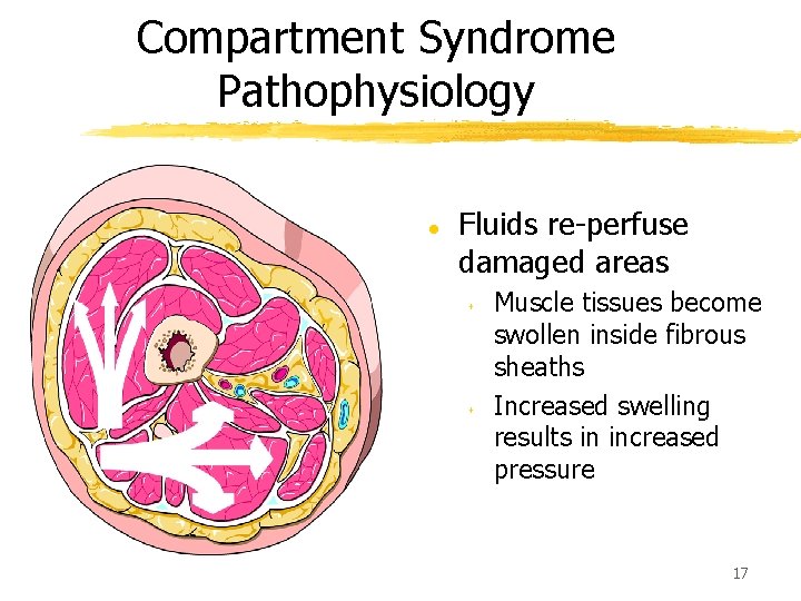 Compartment Syndrome Pathophysiology l Fluids re-perfuse damaged areas s s Muscle tissues become swollen