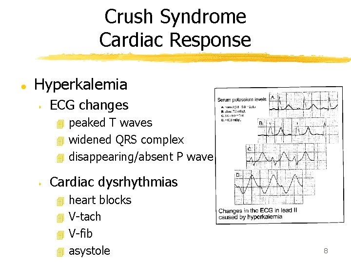 Crush Syndrome Cardiac Response l Hyperkalemia s ECG changes peaked T waves 4 widened