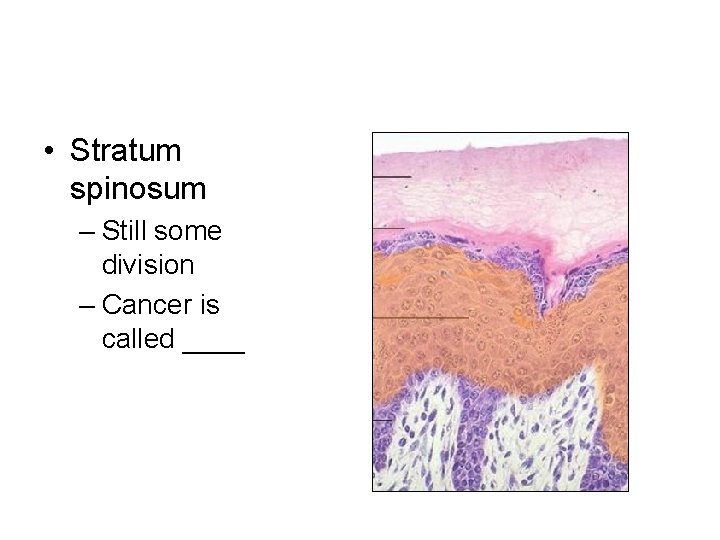  • Stratum spinosum – Still some division – Cancer is called ____ 