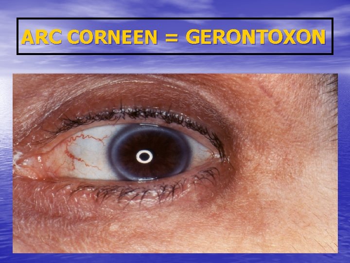 ARC CORNEEN = GERONTOXON 