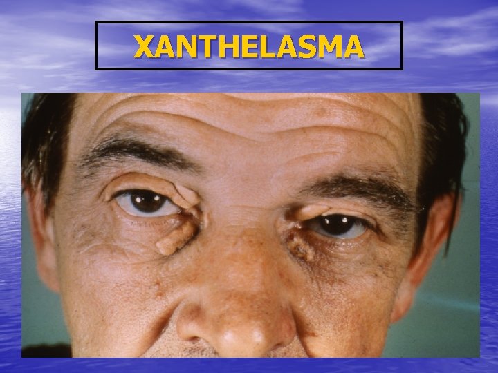 XANTHELASMA 