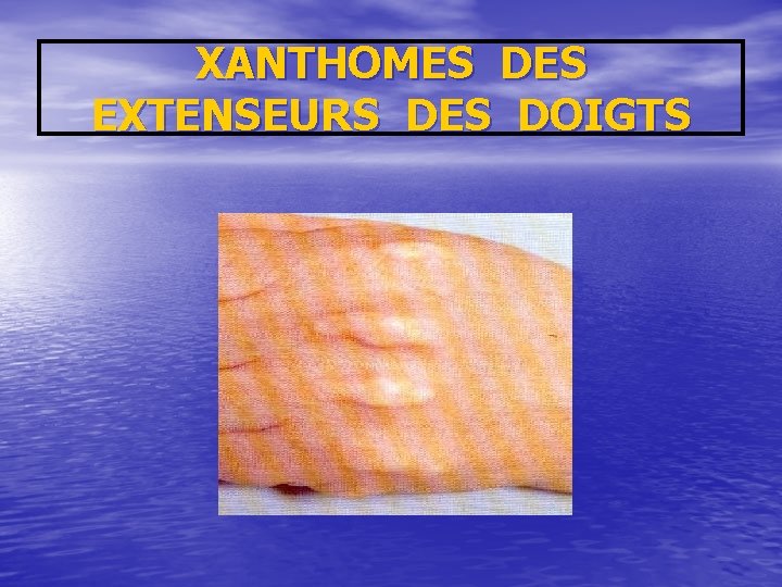 XANTHOMES DES EXTENSEURS DES DOIGTS 