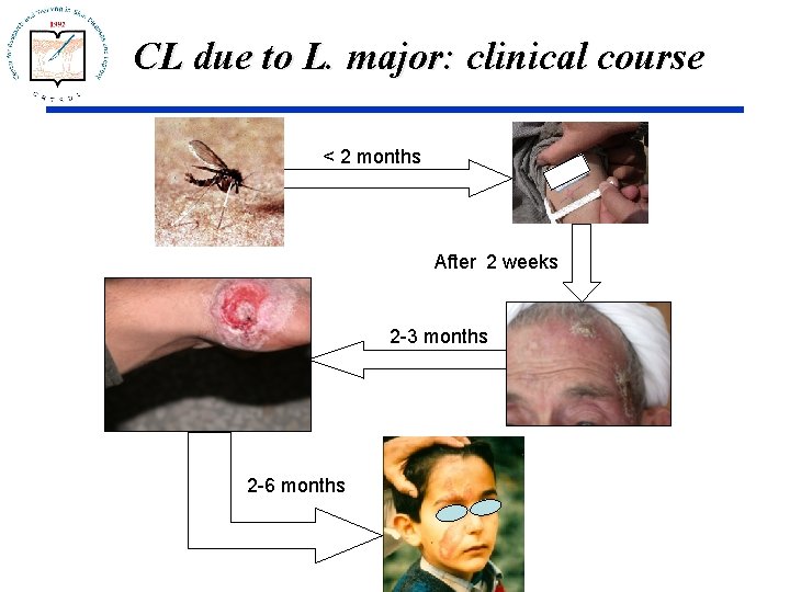 CL due to L. major: clinical course < 2 months After 2 weeks 2