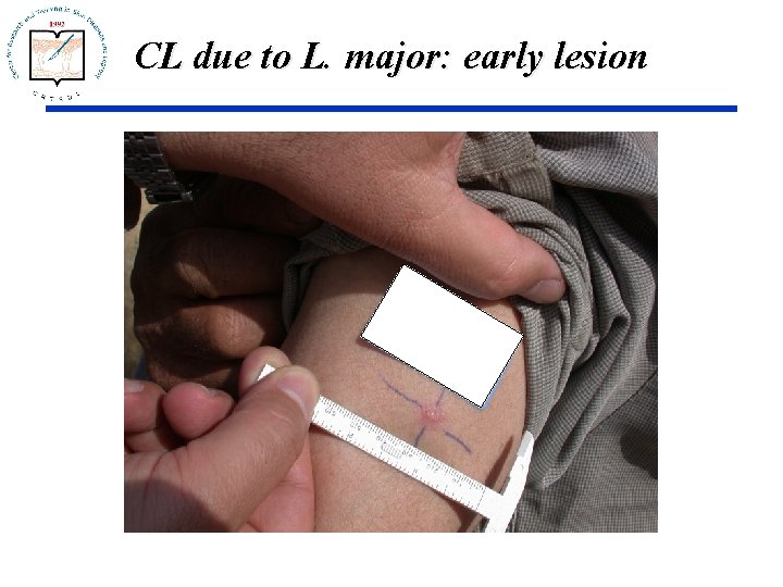 CL due to L. major: early lesion 