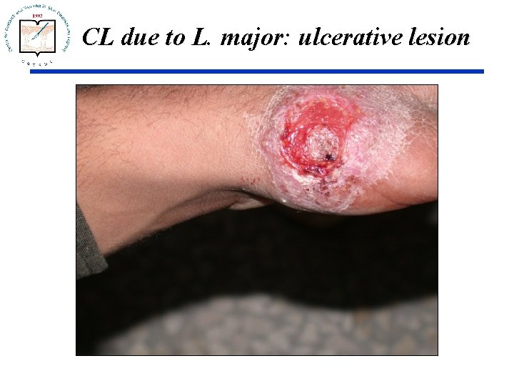 CL due to L. major: ulcerative lesion 
