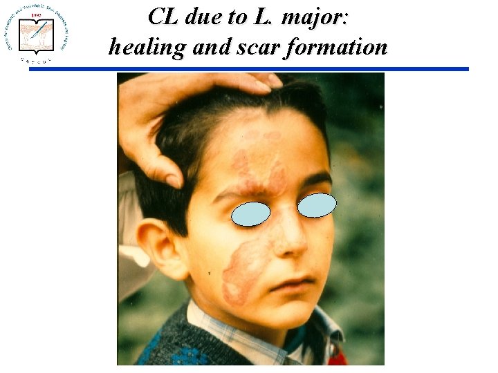 CL due to L. major: healing and scar formation 