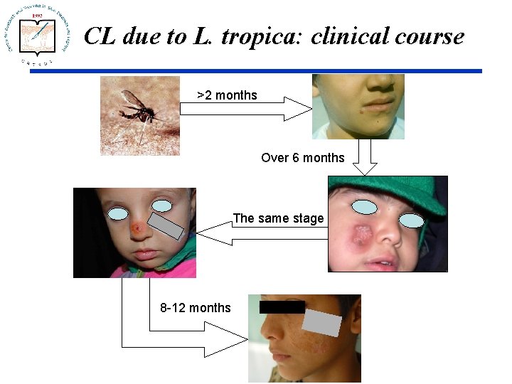 CL due to L. tropica: clinical course >2 months Over 6 months The same