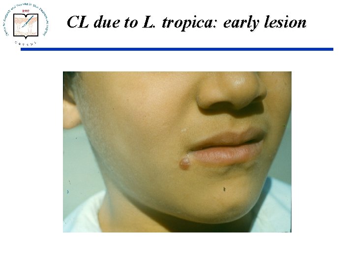 CL due to L. tropica: early lesion 