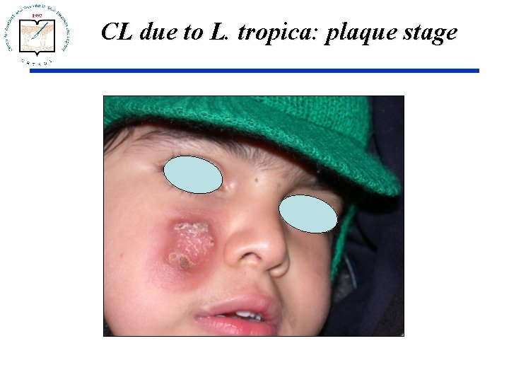 CL due to L. tropica: plaque stage 