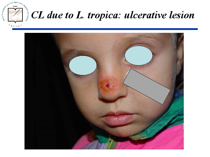 CL due to L. tropica: ulcerative lesion 