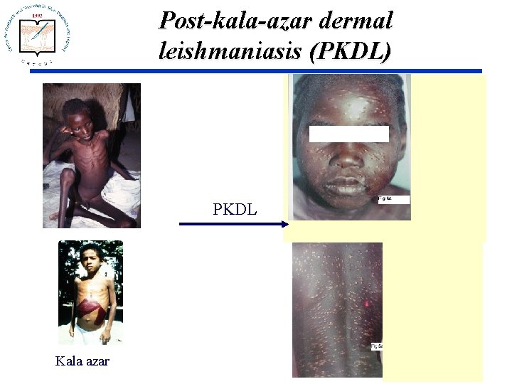 Post-kala-azar dermal leishmaniasis (PKDL) PKDL Kala azar 