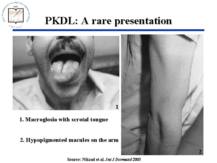 PKDL: A rare presentation 1 1. Macroglosia with scrotal tongue 2. Hypopigmented macules on