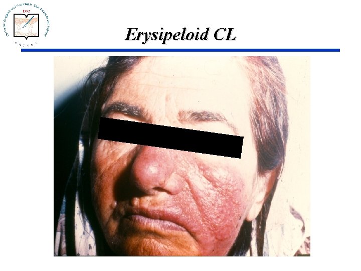 Erysipeloid CL 