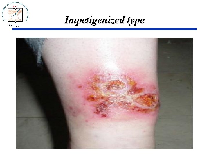 Impetigenized type 