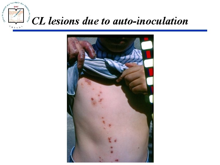 CL lesions due to auto-inoculation 