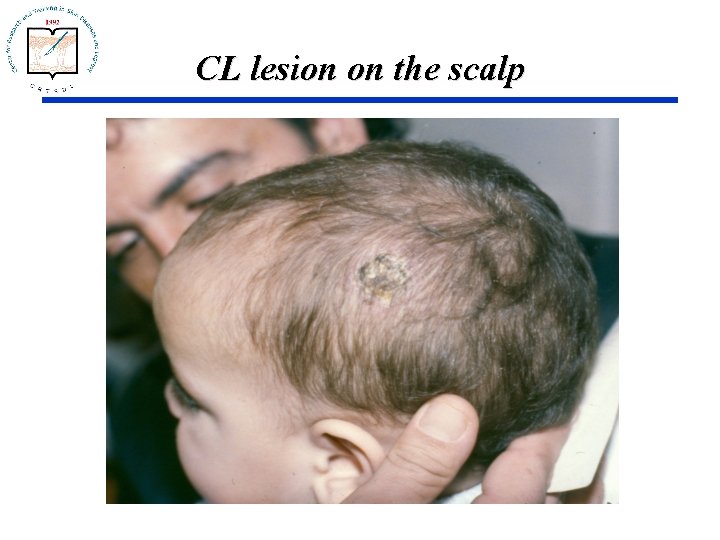CL lesion on the scalp 