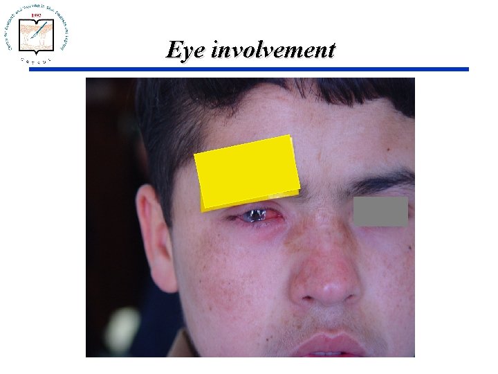 Eye involvement 