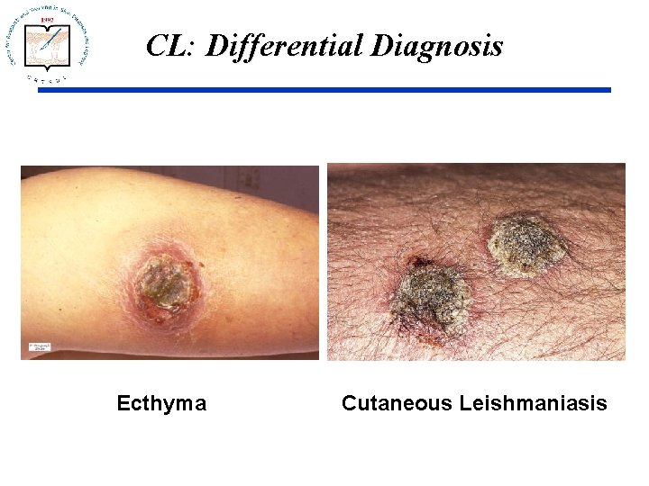 CL: Differential Diagnosis Ecthyma Cutaneous Leishmaniasis 