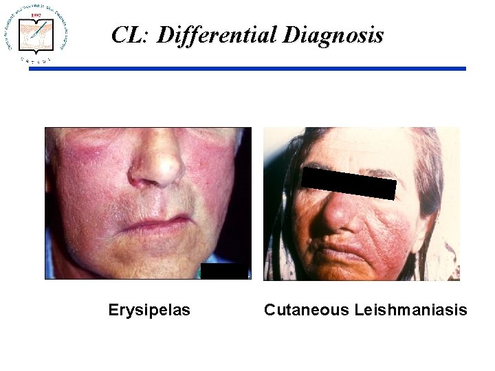 CL: Differential Diagnosis Erysipelas Cutaneous Leishmaniasis 
