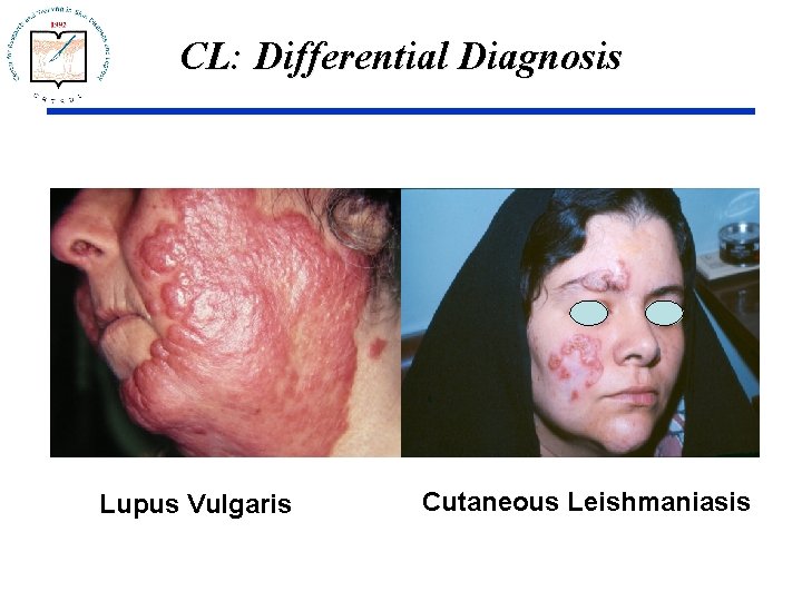 CL: Differential Diagnosis Lupus Vulgaris Cutaneous Leishmaniasis 