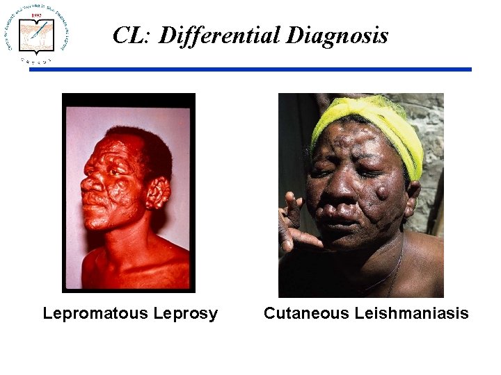 CL: Differential Diagnosis Lepromatous Leprosy Cutaneous Leishmaniasis 