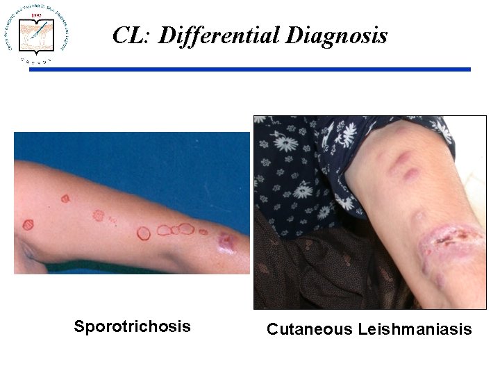 CL: Differential Diagnosis Sporotrichosis Cutaneous Leishmaniasis 