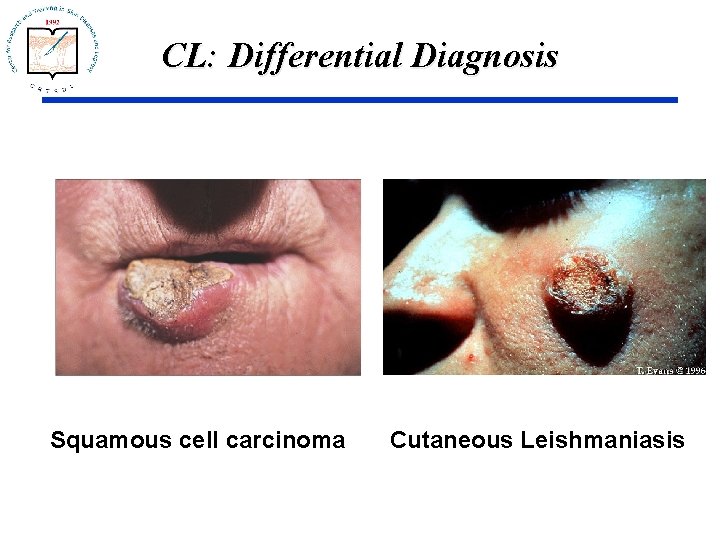 CL: Differential Diagnosis Squamous cell carcinoma Cutaneous Leishmaniasis 