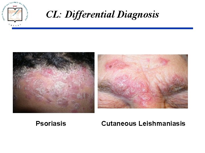 CL: Differential Diagnosis Psoriasis Cutaneous Leishmaniasis 