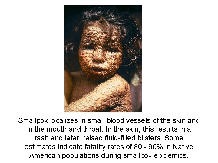 Smallpox localizes in small blood vessels of the skin and in the mouth and