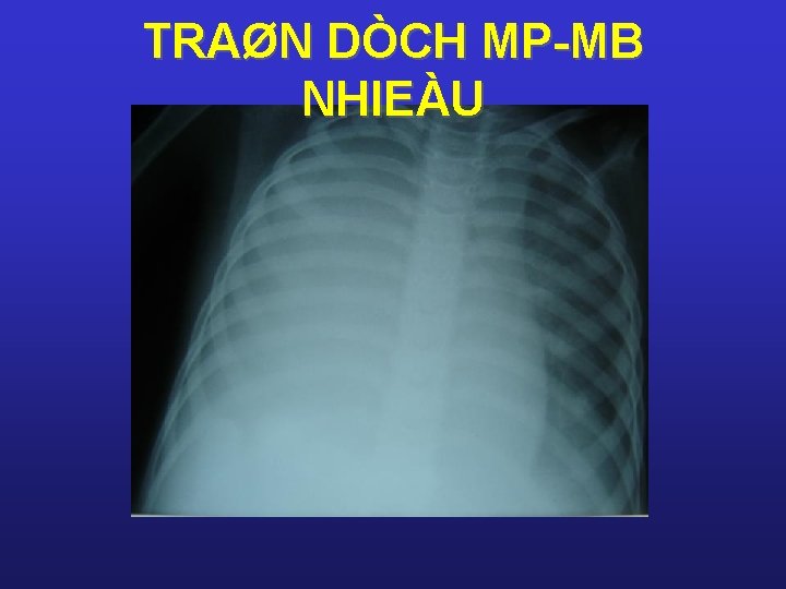 TRAØN DÒCH MP-MB NHIEÀU 