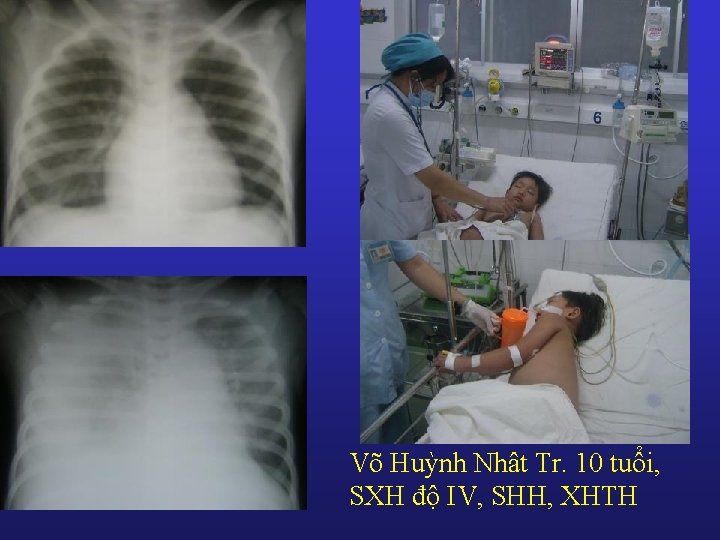 Võ Huỳnh Nhât Tr. 10 tuổi, SXH độ IV, SHH, XHTH 