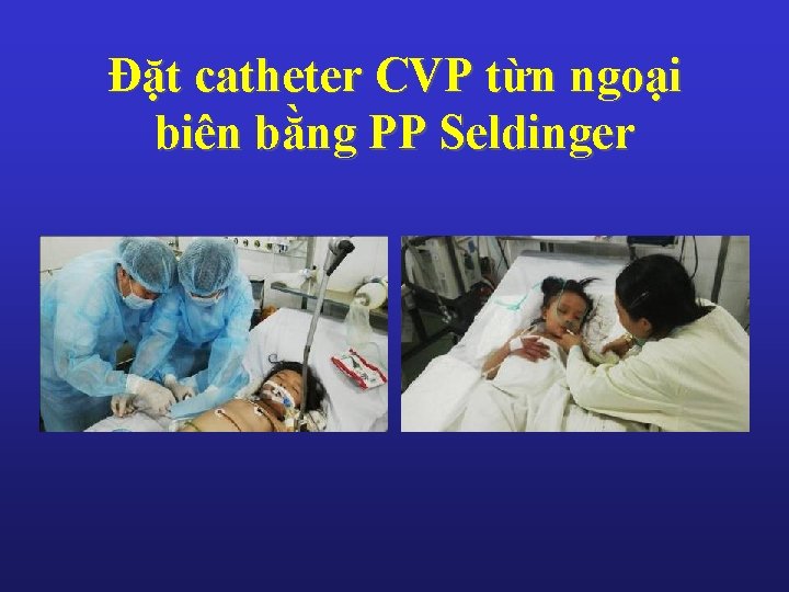 Đặt catheter CVP từn ngoại biên bằng PP Seldinger 