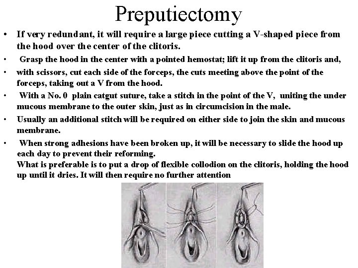  Preputiectomy • If very redundant, it will require a large piece cutting a