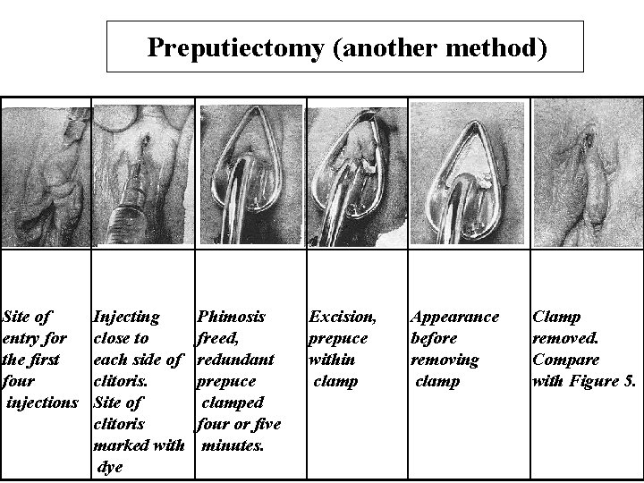 Preputiectomy (another method) Site of entry for the first four injections Injecting close to