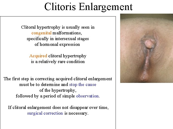 Clitoris Enlargement Clitoral hypertrophy is usually seen in congenital malformations, specifically in intersexual stages