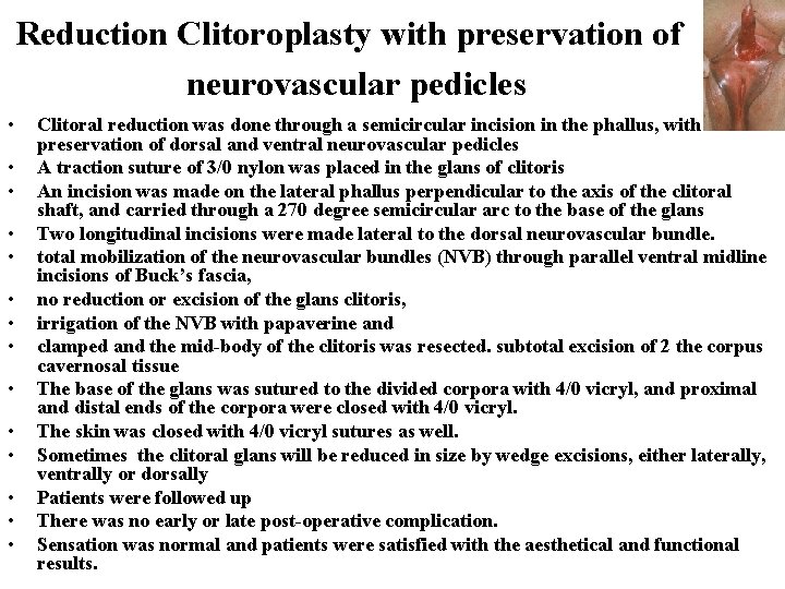 Reduction Clitoroplasty with preservation of neurovascular pedicles • • • • Clitoral reduction was