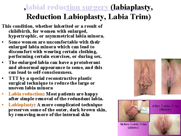 , labial reduction surgery (labiaplasty, Reduction Labioplasty, Labia Trim) This condition, whether inherited or