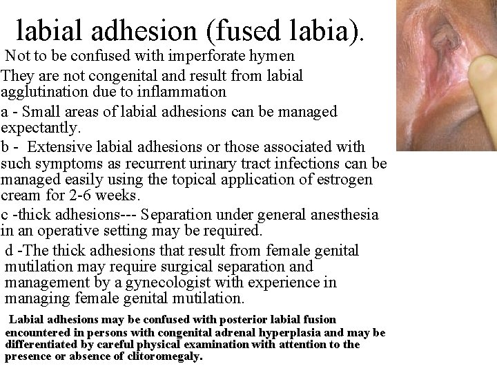 labial adhesion (fused labia). Not to be confused with imperforate hymen They are not