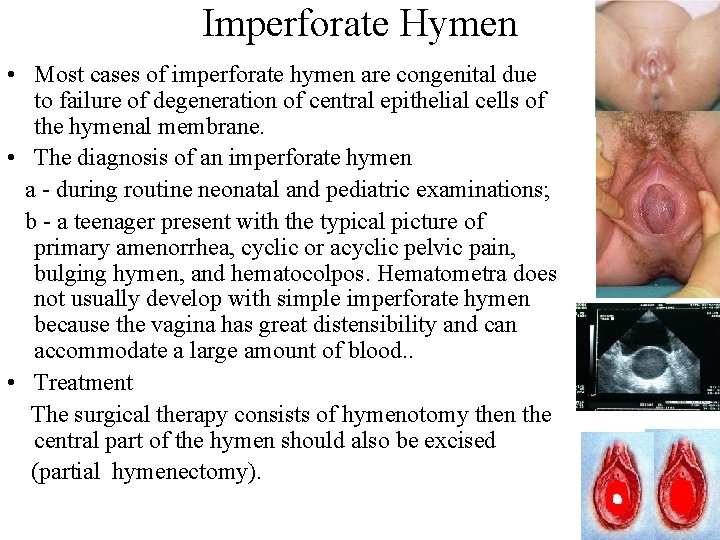 Imperforate Hymen • Most cases of imperforate hymen are congenital due to failure of