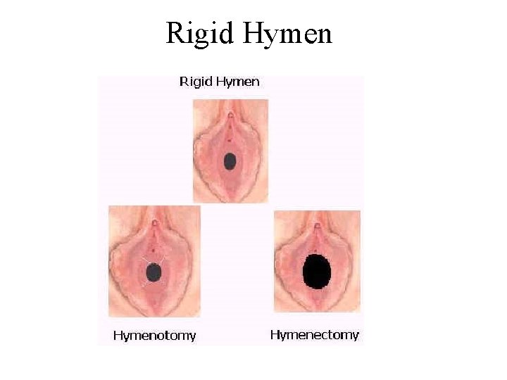 Rigid Hymen 