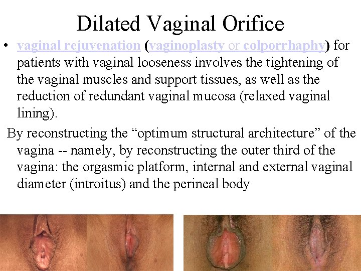 Dilated Vaginal Orifice • vaginal rejuvenation (vaginoplasty or colporrhaphy) for patients with vaginal looseness