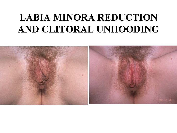 LABIA MINORA REDUCTION AND CLITORAL UNHOODING 