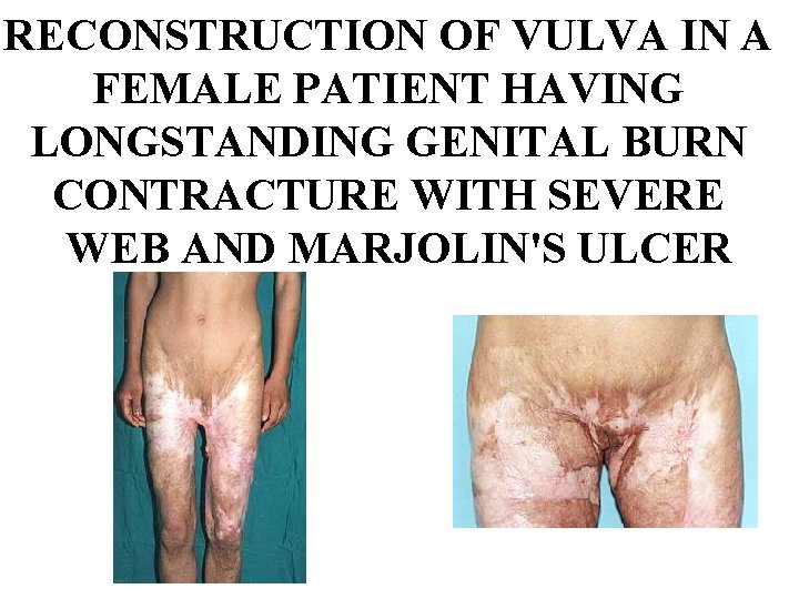 RECONSTRUCTION OF VULVA IN A FEMALE PATIENT HAVING LONGSTANDING GENITAL BURN CONTRACTURE WITH SEVERE