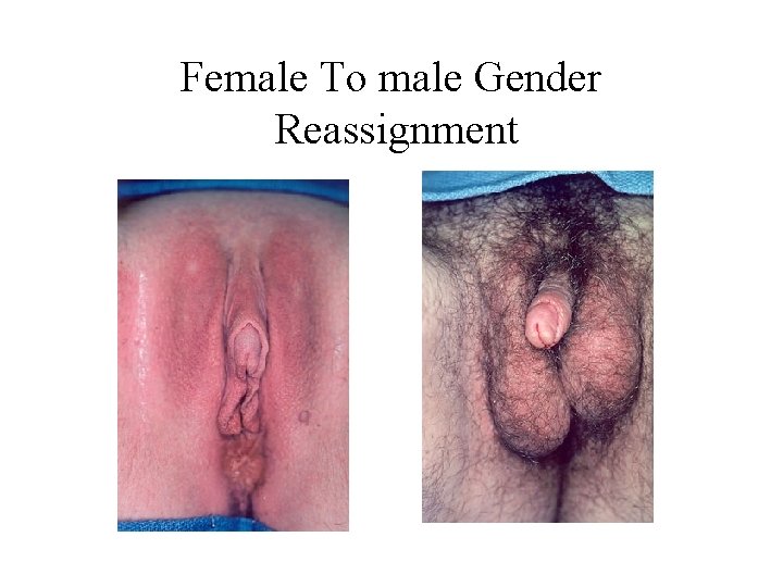 Female To male Gender Reassignment 