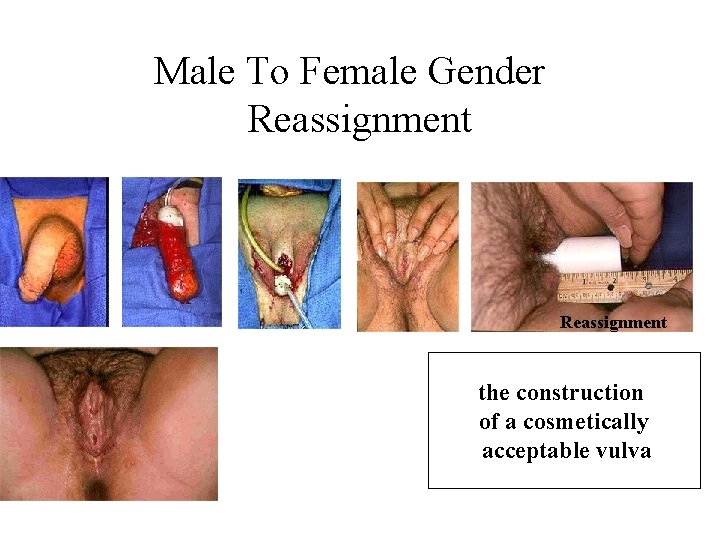 Male To Female Gender Reassignment the construction of a cosmetically acceptable vulva 