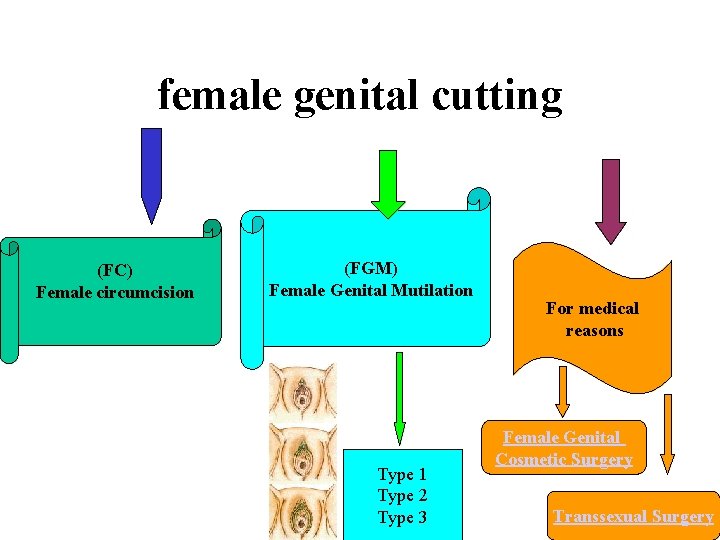 female genital cutting (FC) Female circumcision (FGM) Female Genital Mutilation Type 1 Type 2