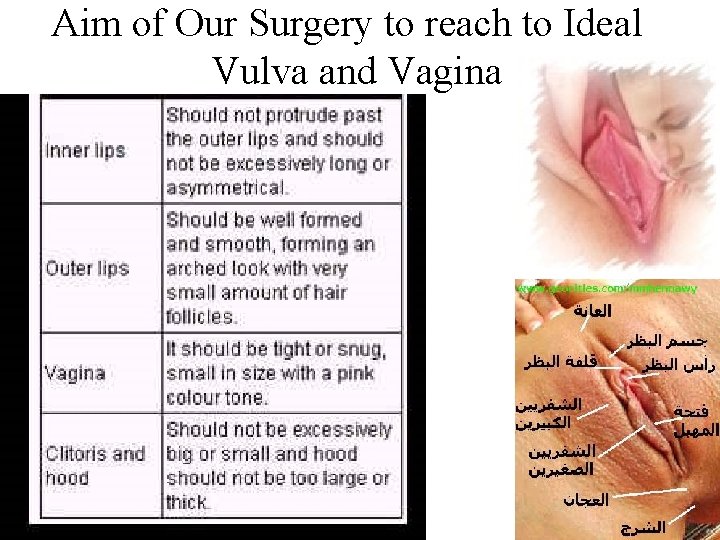 Aim of Our Surgery to reach to Ideal Vulva and Vagina 