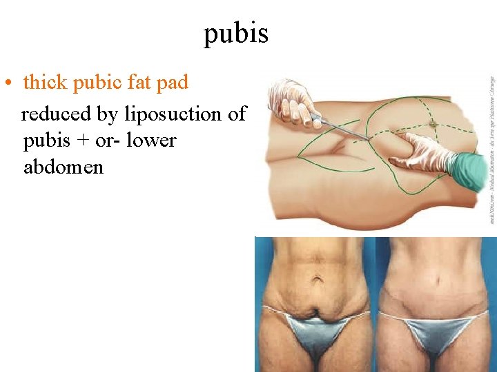 pubis • thick pubic fat pad reduced by liposuction of pubis + or- lower